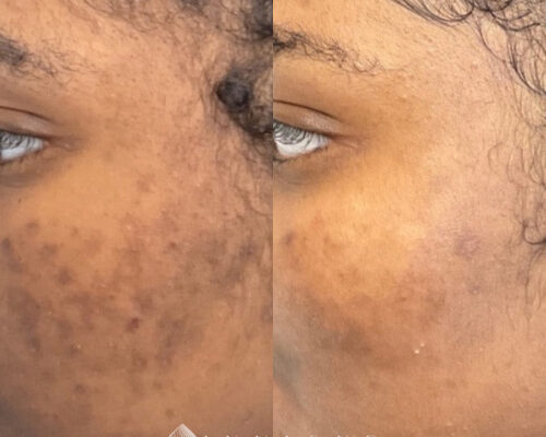 Microneedling a2