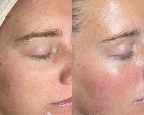 Microneedling a4