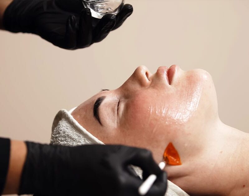 woman getting a chemical peel in Ashburn, VA