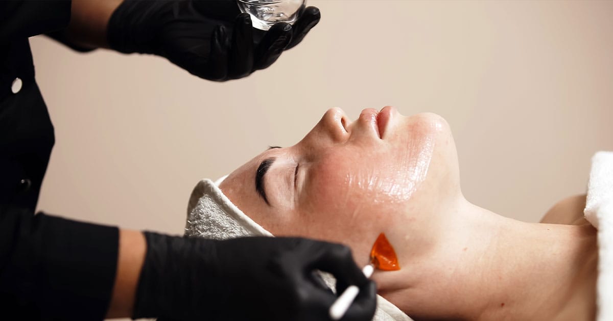 woman getting a chemical peel in Ashburn, VA