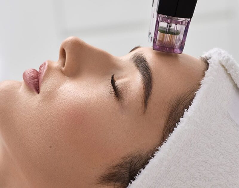 woman getting microneedling in Ashburn, VA