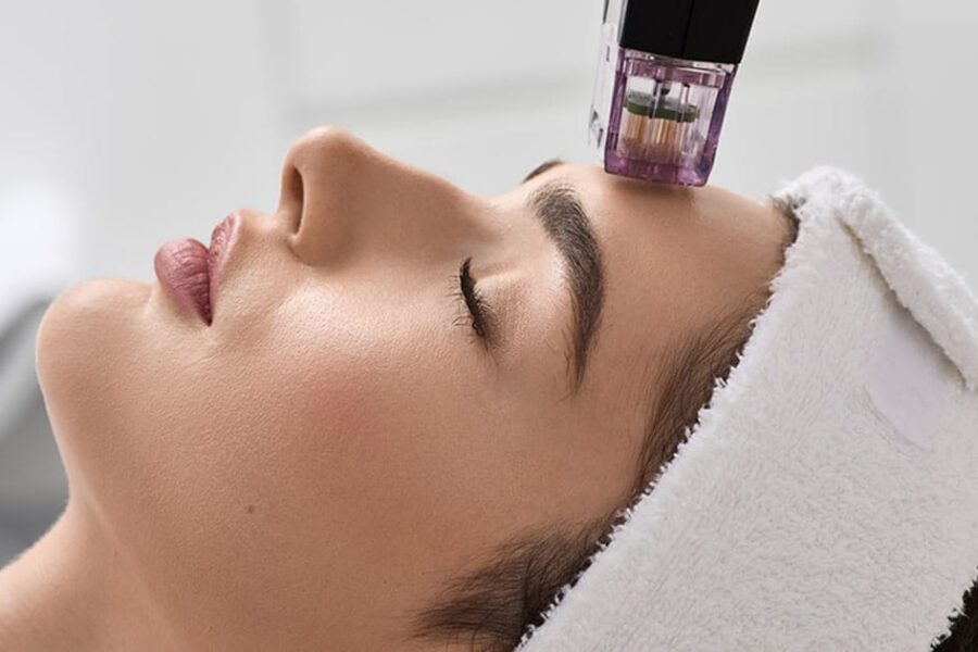 woman getting microneedling in Ashburn, VA